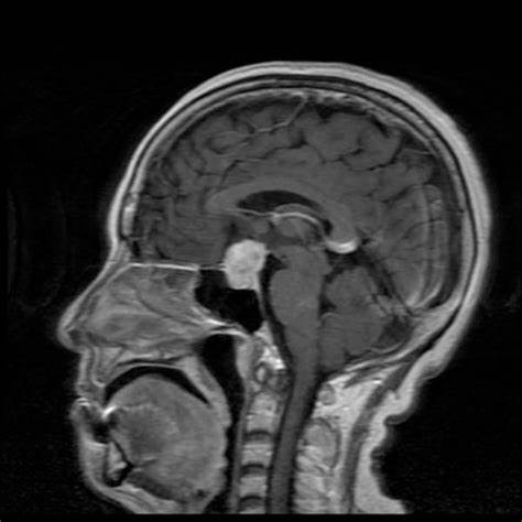 Brain MRI Scan